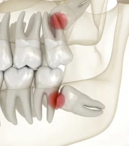 Dentistes à Marquette-lez-Lille 59520 : dents de sagesse