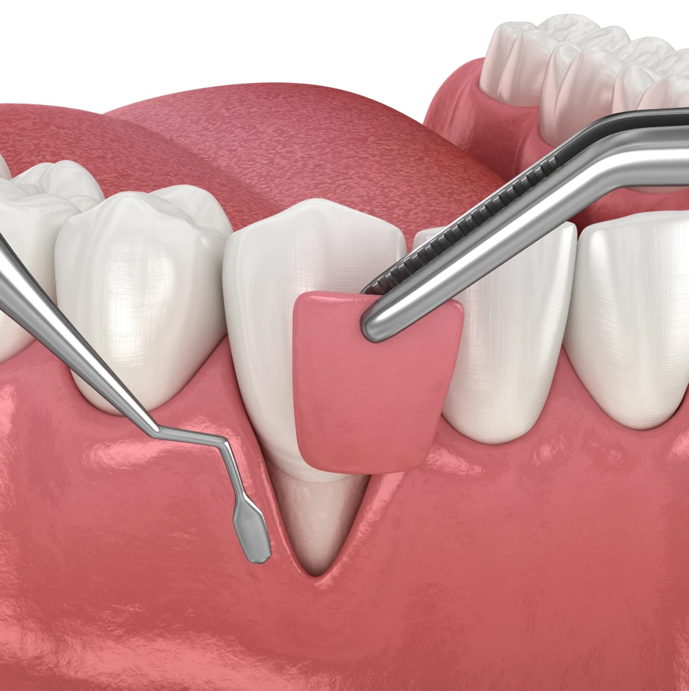 La greffe de gencives permet de protéger les dents et d'améliorer le confort quotidien.